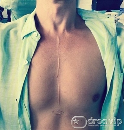 Globo se ‘esquece’ de cicatriz de Gianecchini, e novela tem correria