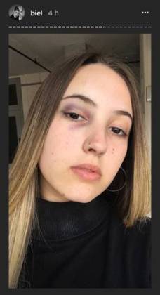 Biel mostra a irmã Giovanna com hematomas/Instagram