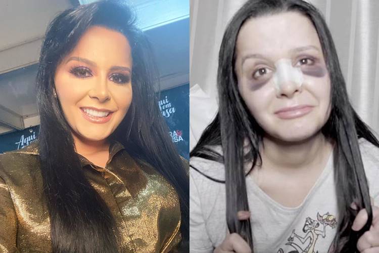 Após rinoplastia, Maraisa surge com olheiras e reclama na web