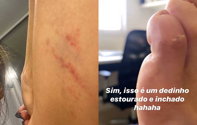 Machucados da Lexa - Reprodução: Instagram Stories