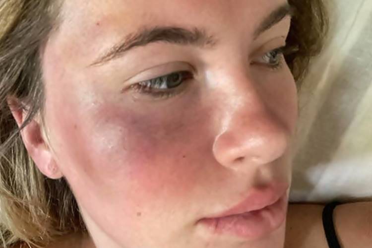 Filha de atores mostra rosto machucado e relata agressão: ''Louca por dinheiro'' - Foto: Reprodução/Instagram@irelandbasingerbaldwin