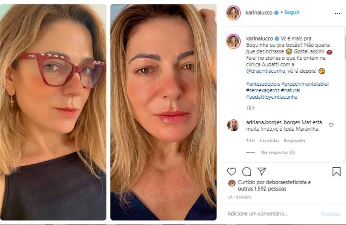 Após realizar procedimento estético, Karina Lucco mostra antes e depois - Foto: Reprodução/Instagram@karinalucco