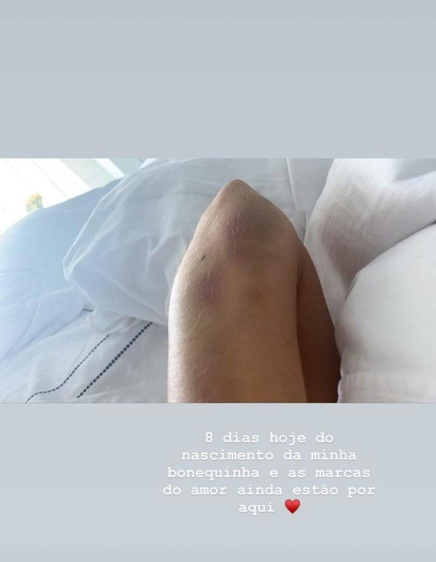Romana Novais exibe hematomas após parto de emergência: ''Marcas do amor'' - Foto: Reprodução/Instagram