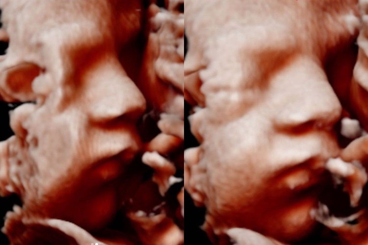 Grávida, Gabi Brandt mostra rostinho de bebê no ultrassom - Foto: Reprodução/Instagram