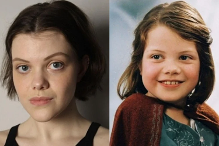 Atriz de ‘As Crônicas de Nárnia’ quase perde braço com doença ‘carnívora’