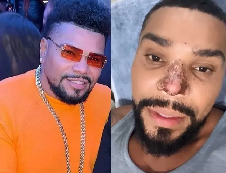 Naldo Benny se pronuncia após princípio de necrose no nariz ''Muito