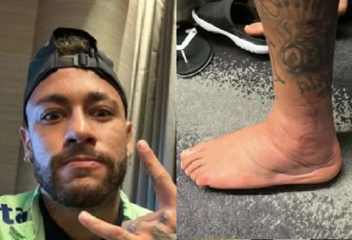 Neymar mostra seu tornozelo lesionado (Foto: Stories do Instagram)