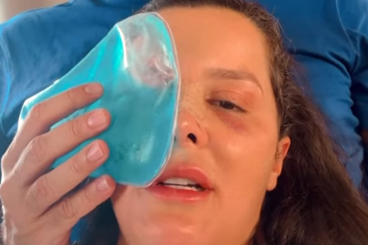 Cantora Maraisa aparece com o nariz quebrado e tranquiliza fãs após acidente