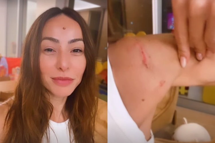Sabrina Sato exibe lesões causadas por fantasias do Carnaval: “dor terrível”