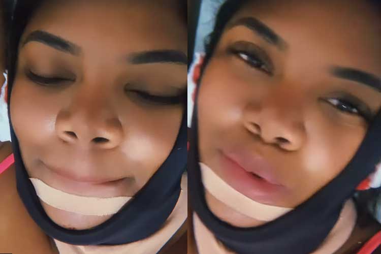 Raquel Brito, irmã de Davi Brito, surge com rosto enfaixado após cirurgia e explica motivo