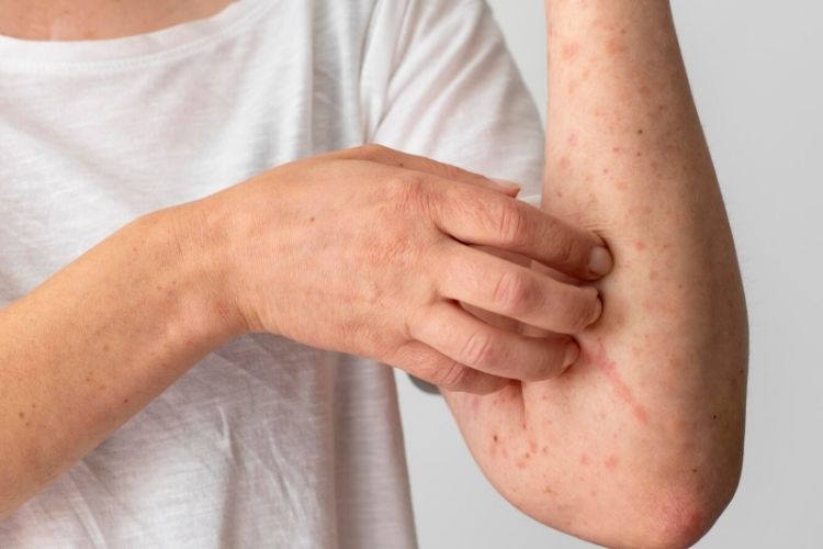 Pessoa com sintoma de sarampo