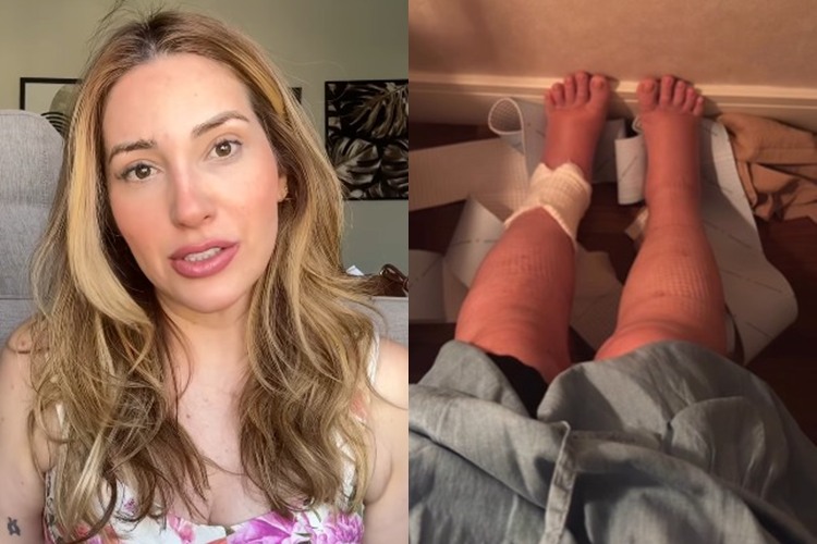 Amanda Meirelles passa por cirurgia de lipedema e relata dores e desconfortos