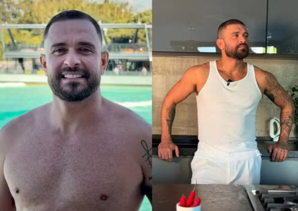 Cantor tamb&eacute;m fez implante capilar.