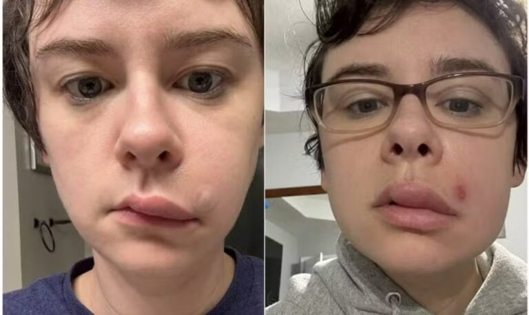 Mulher quase perde os movimentos do rosto após espremer espinha