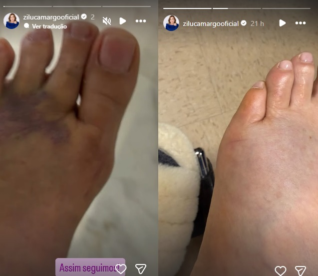 Zilu Camargo mostra como ficou o pé após acidente (Foto: Instagram)