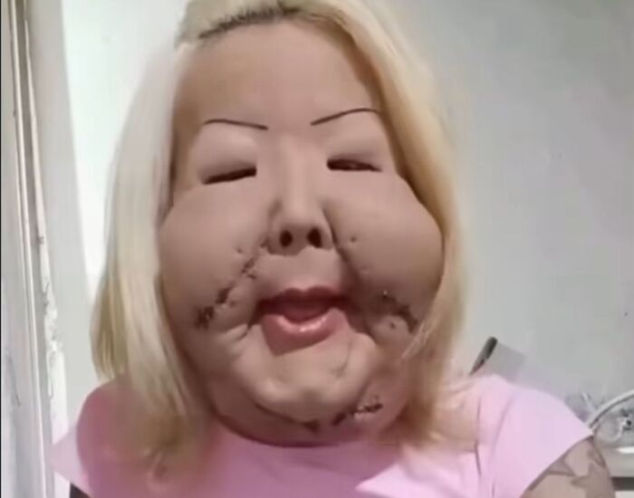 Rosto da Juju do pix após 10 dias de procedimento Rosto da Juju do pix após 10 dias de procedimento