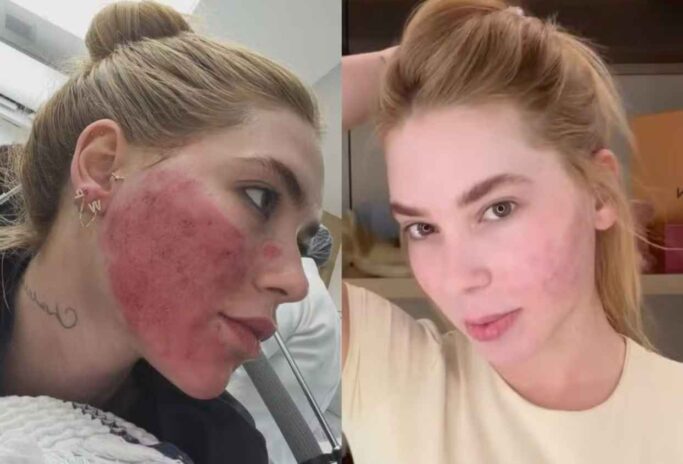Virginia mostra antes e depois aos seguidores - Reprodução: Instagram Virginia mostra antes e depois aos seguidores - Reprodução: Instagram