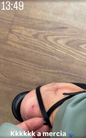 Virginia mostra o machucado nas redes sociais - Reprodução: Instagram Virginia mostra o machucado nas redes sociais - Reprodução: Instagram