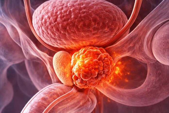 Câncer de Próstata