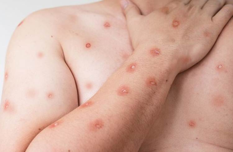 Mpox - Ministério da Saúde