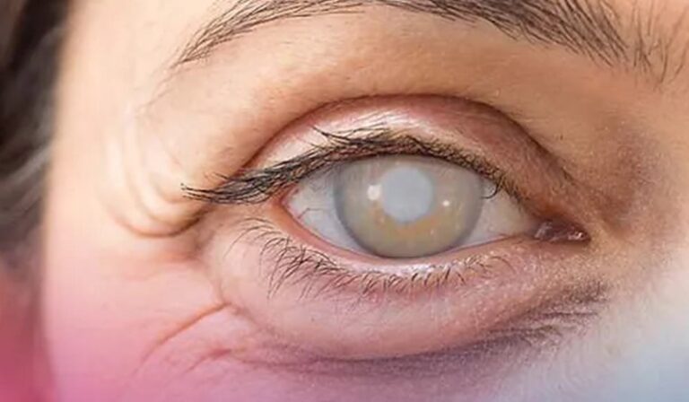 Cresce número de diagnósticos de catarata no Brasil, problema é considerado a ‘doença do século’