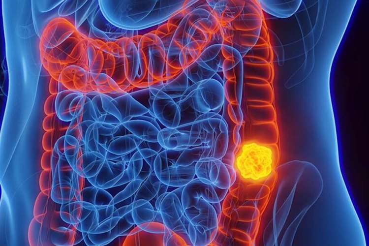 Câncer de Intestino é mais comum do que se imagina, veja sintomas!