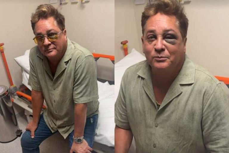 Após acidente, Leonardo vai parar no hospital com o olho roxo
