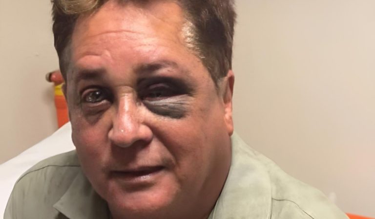 Leonardo conta como fraturou osso acima do olho: “Tava mamado”