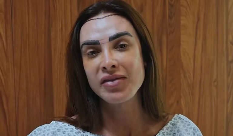 Nicole Bahls toma atitude após diagnóstico de alopecia: ‘Mais feliz e mais cabeluda’