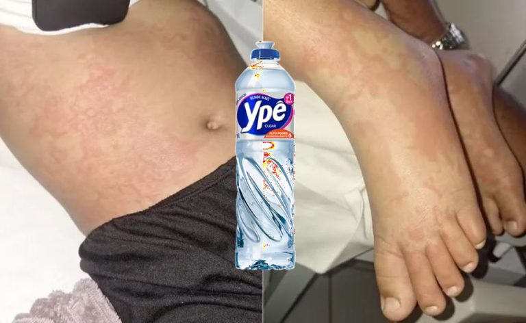 Criança luta pela vida após contato com detergente Ypê