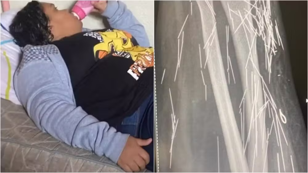 Raio-X mostrou que mulher de 37 anos fingia ter 12 anos tem agulhas pelo corpo Raio-X mostrou que mulher de 37 anos fingia ter 12 anos tem agulhas pelo corpo (Foto: Reprodução)