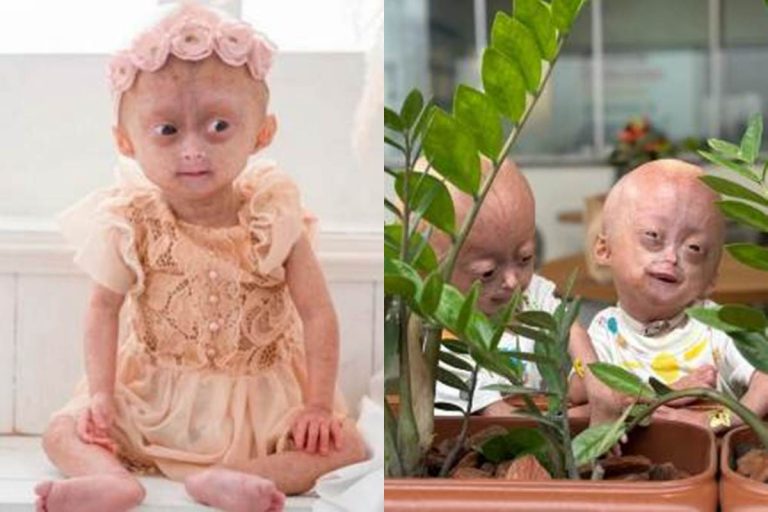 Morre influenciadora mirim, uma das gêmeas com síndrome rara de envelhecimento precoce