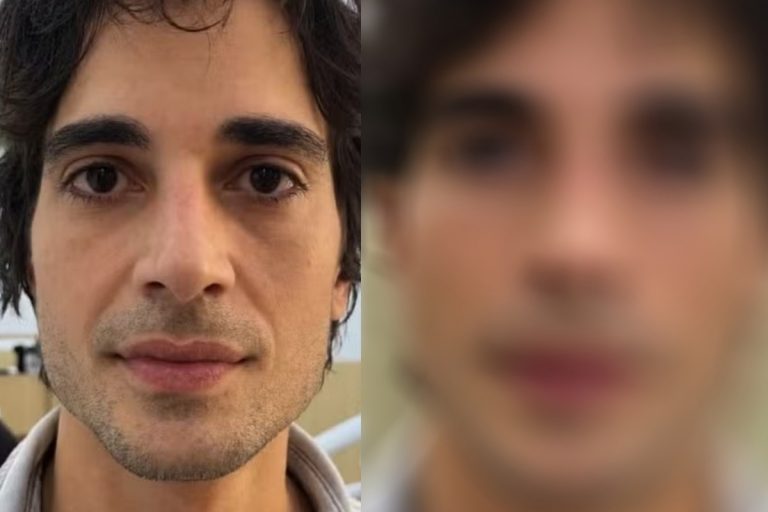 Fiuk faz harmonização facial após revelar crise financeira